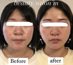 beauty salon M 肌質改善ハーブピーリング・小顔ハイフ